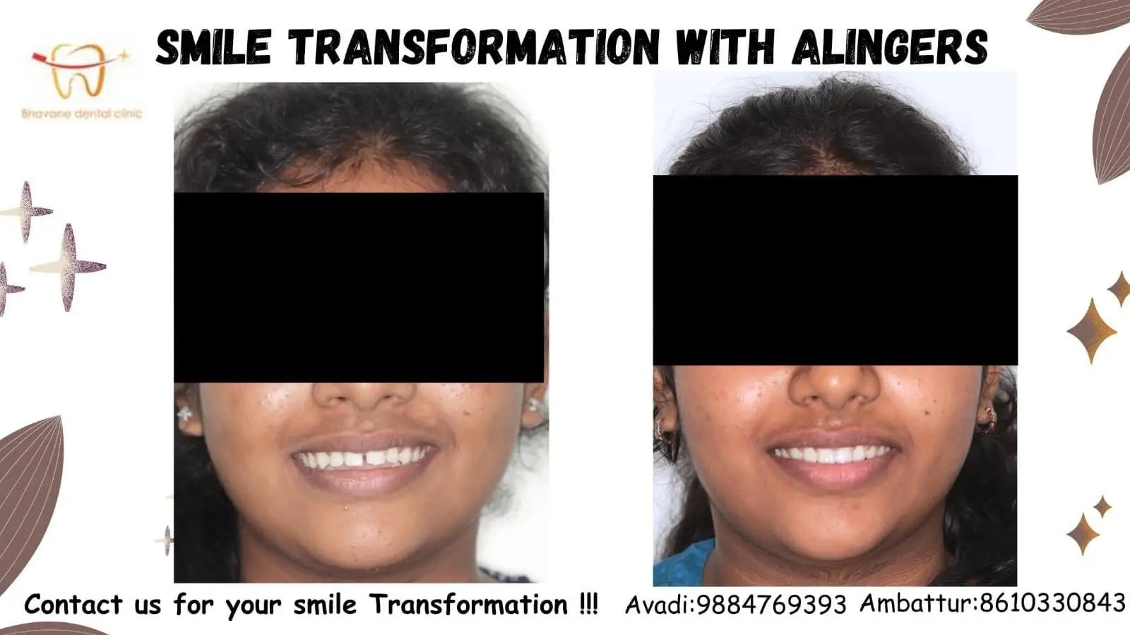 Clear Aligners Gap Closure - Dr. Srujayeeni