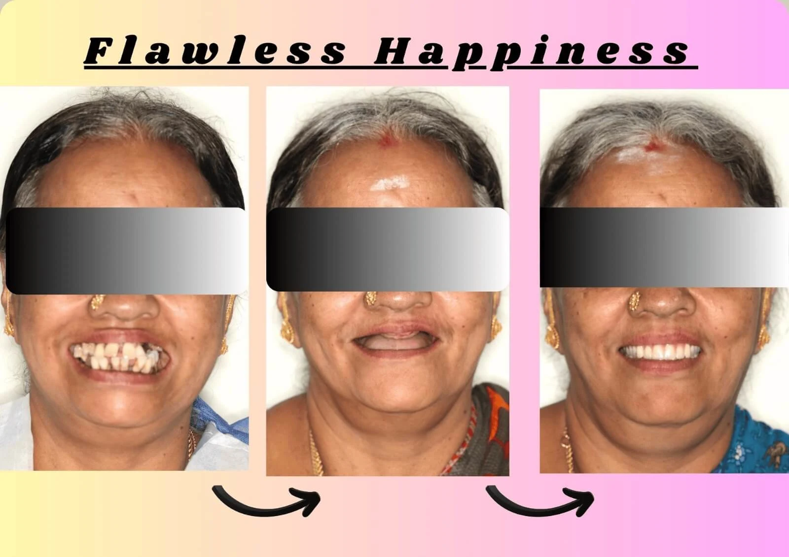 Full Mouth Rehabilitation Dental Implants - Bhavane Dental Clinic