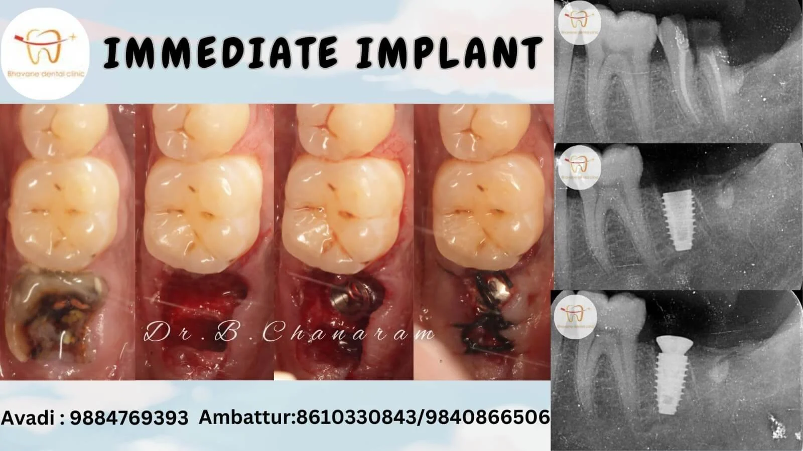Immediate Dental Implant - Bhavane Dental Clinic