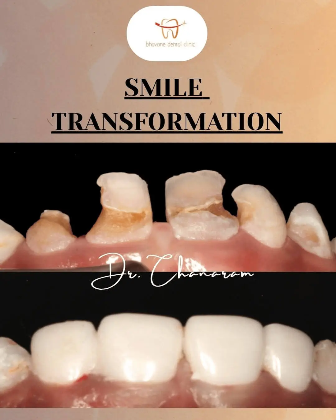 Pediatric Zirconia Crowns - Dr. B. Chanaram