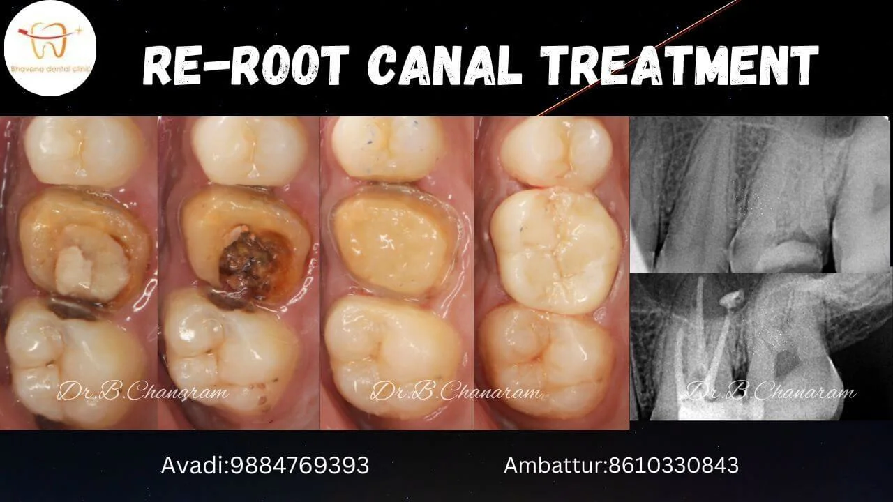 Laser Root Canal Clinical Case - Bhavane Dental Clinic