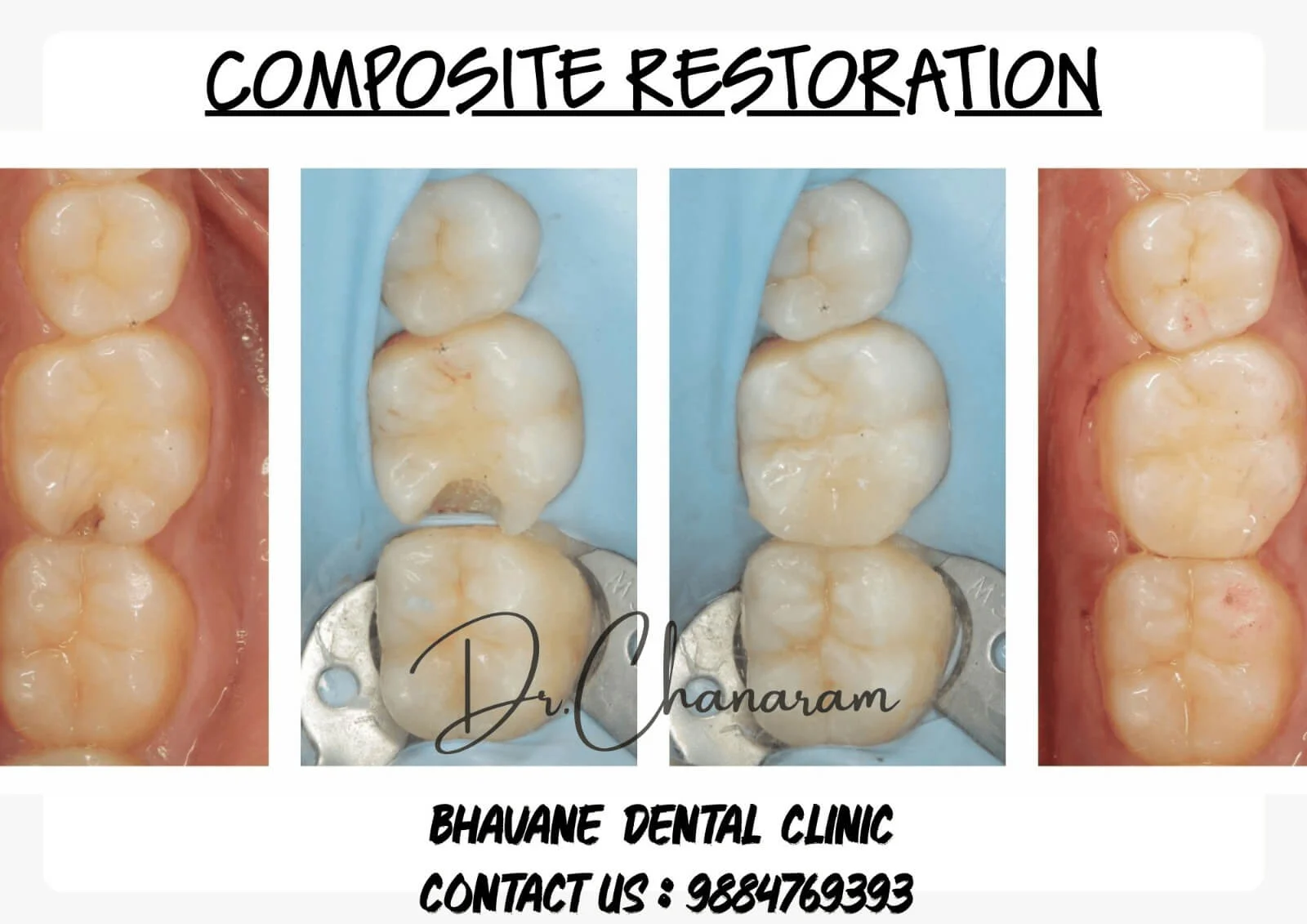 Posterior Composite Tooth Restoration - Dr. Srujayeeni