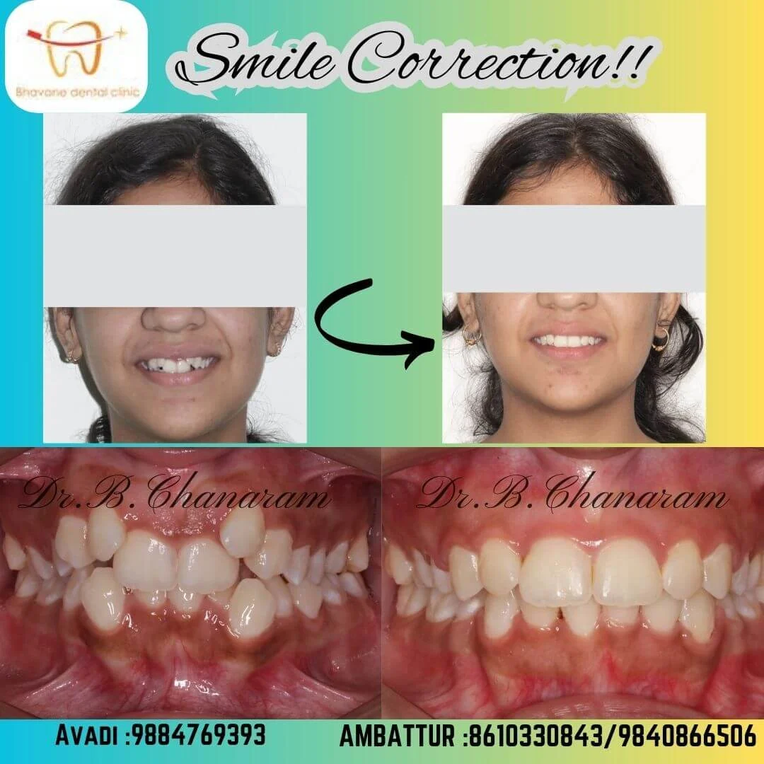 Crowding Correction with Clear Aligners - Dr. Srujayeeni