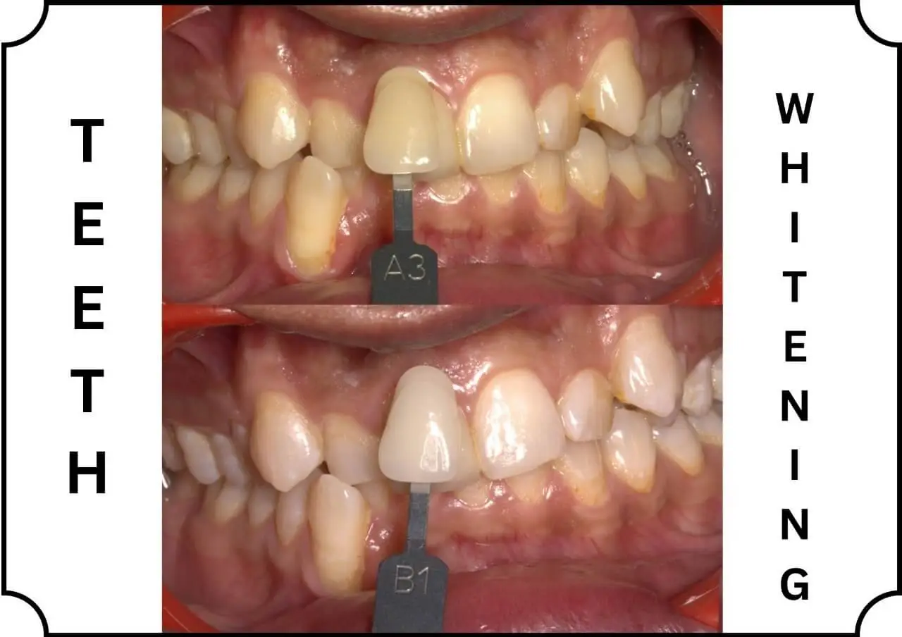 In-Clinic Laser Teeth Whitening - Bhavane Dental Clinic