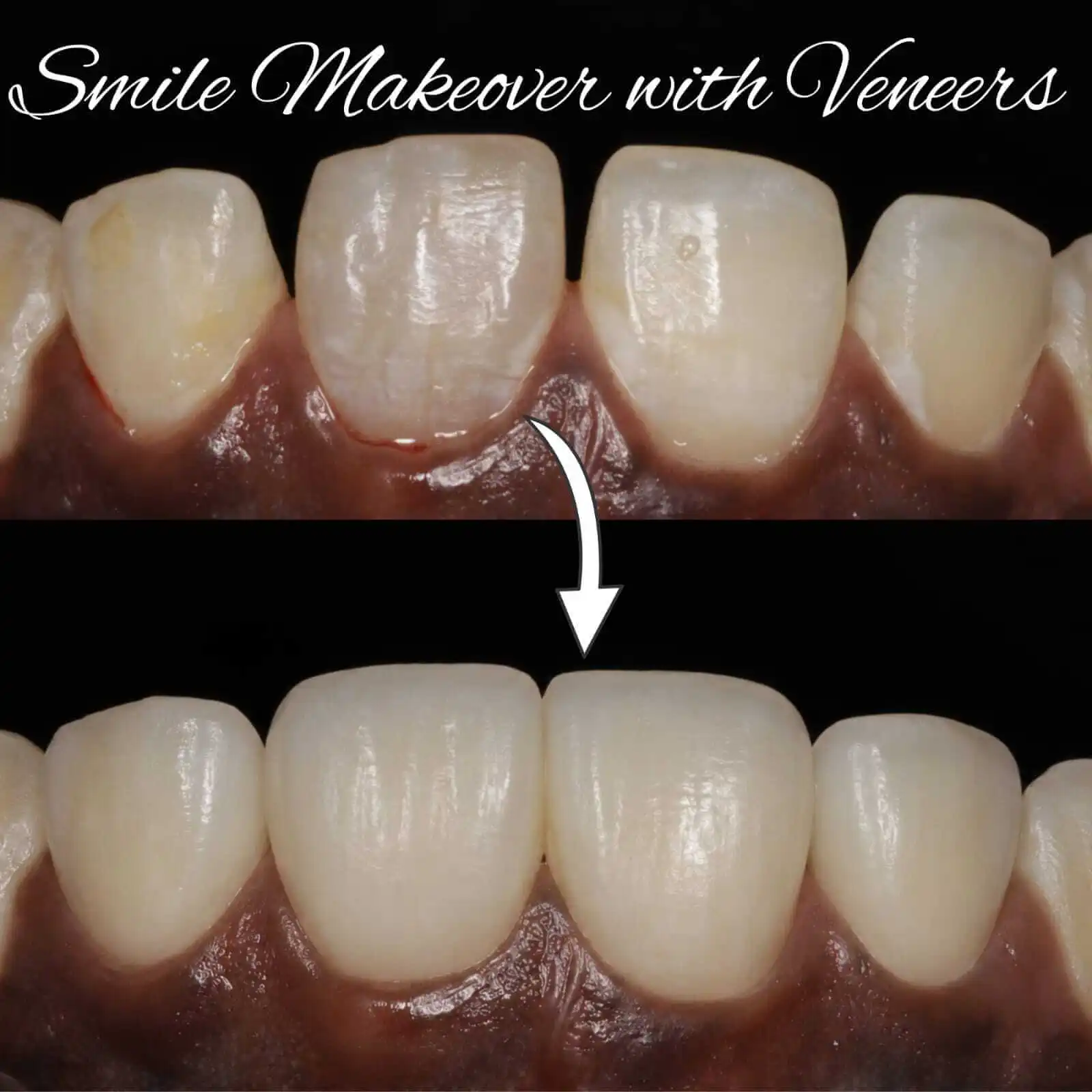 Veneers Smile Makeover - Dr. Srujayeeni